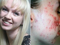Harriet mala pleť posiatu vyrážkami, tomu je však koniec Harriet mala pleť posiatu vyrážkami, tomu je však koniec