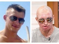 Na Daniela zaútočila priateľka kyselinou sírovou Na Daniela zaútočila priateľka kyselinou sírovou