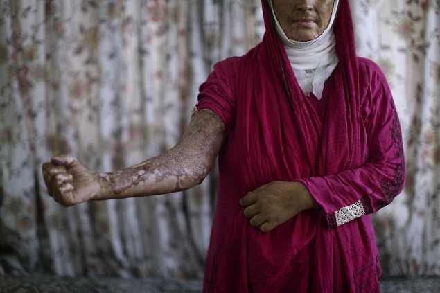 Sajda Ansar (26) ukazuje popáleniny, ktoré jej spôsobil manžel v roku 2011.