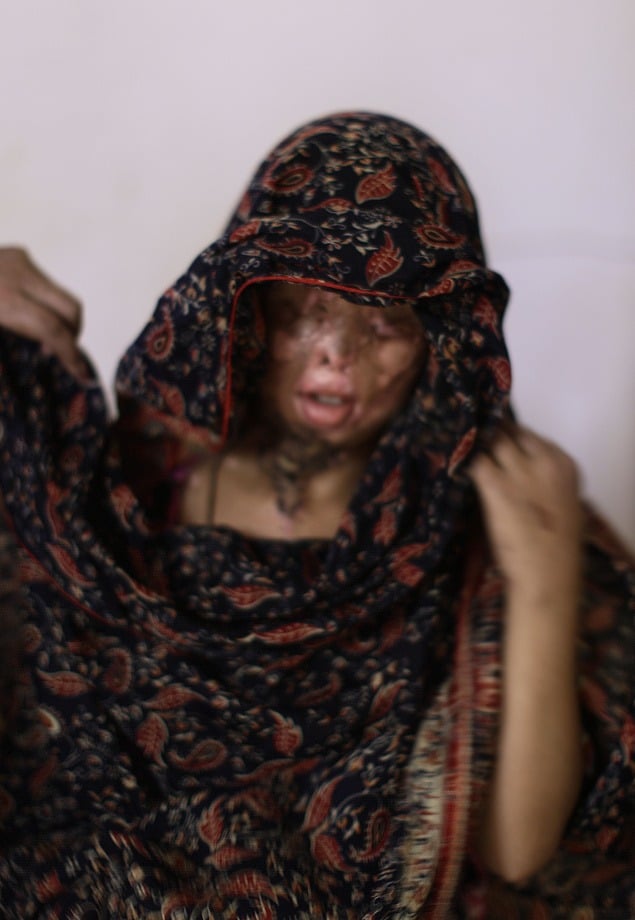 Zaiba Aslam má iba 10 rokov. Po znetvorení odmietnutým nápadnikom prišla o tvár.