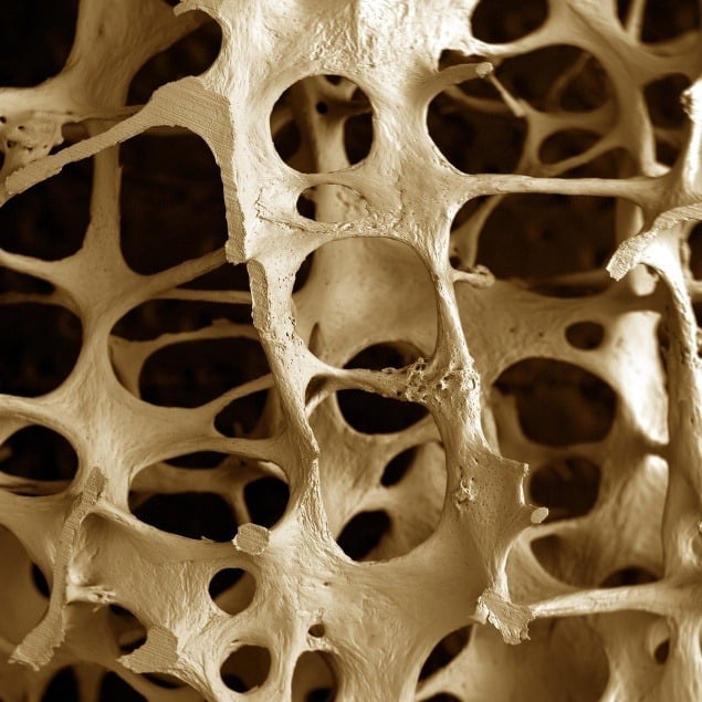 Osteoporóza kostí 89-ročnej ženy.