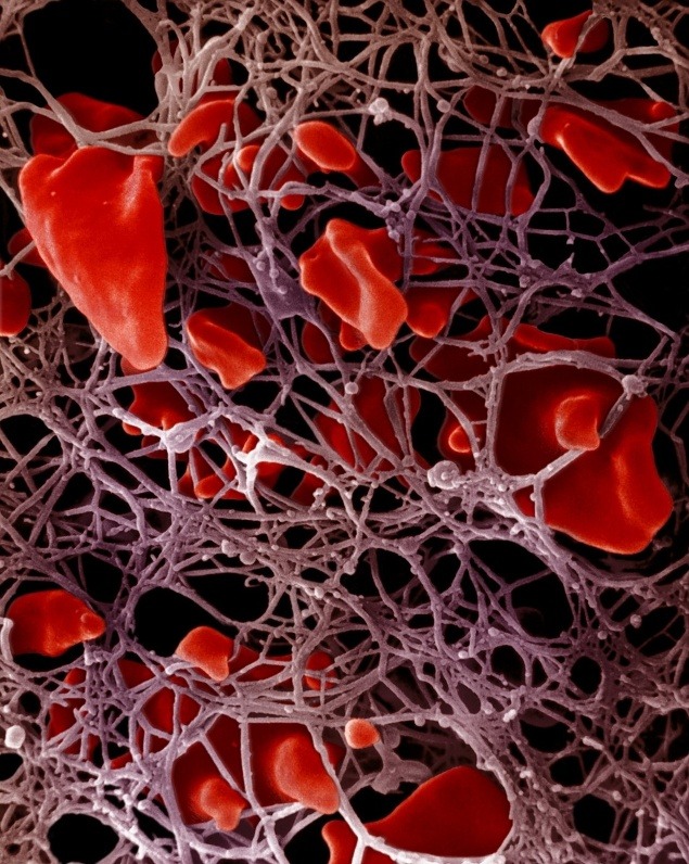 Zrážanie: Červené krvinky uväznené vo fibríne.