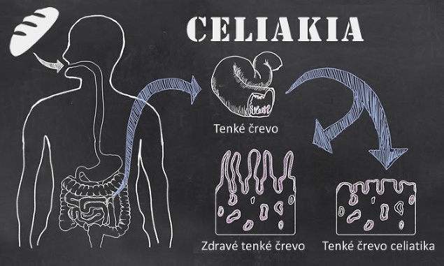 Infografika - Celiakia