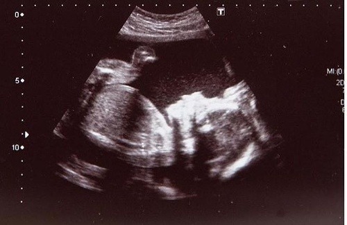 Neskutočný ultrazvuk dokazuje: Britka