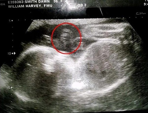 Železné bábätko: Na ultrazvuku