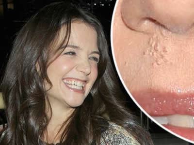 zuby-usmev-herpes-Katie-Holmes.jpg