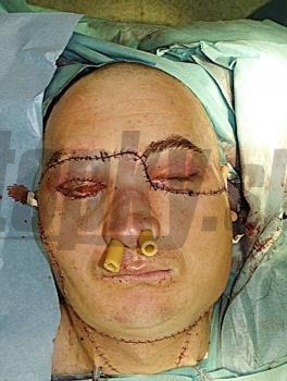 Transplantácia tváre