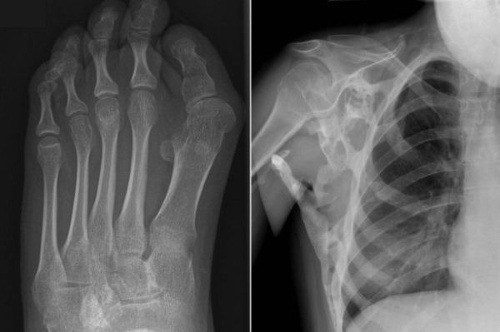 Na röntgenovej snímke vidno vytŕčajúce FOP kosti