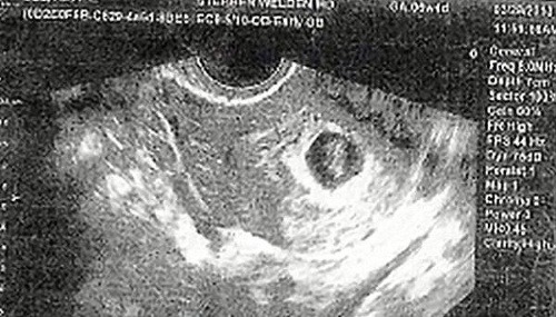 Ultrazvuk dieťatka, keď malo šesť týždňov