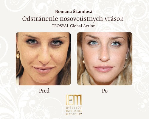 Romana Škamlová pred a po zákroku