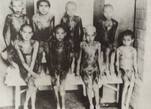 Deti boli v Auschwitzi vystavené lekárskym pokusom. Ich pokožka dostala čierny nádych po tom, ako utrpeli popáleniny z radiácie