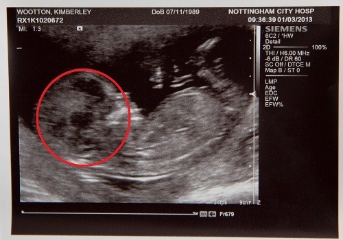 Strašidelný detail na ultrazvuku: