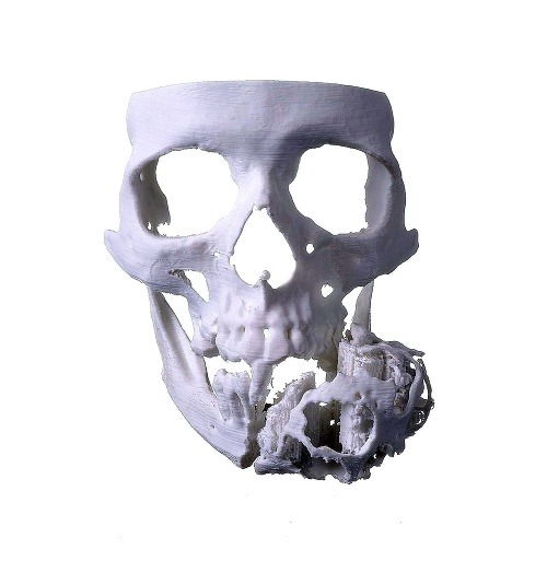 3D model zhotovený z CT hlavy pre maxilofaciálnych chirurgov z Univerzitnej nemocnice v Bratislave – Ružinov. Živý pacient pred operačným zákrokom s rozsiahlym osteogénnym tumorom