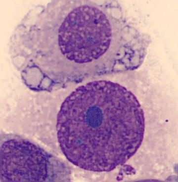 Nádorová bunka pod mikroskopom