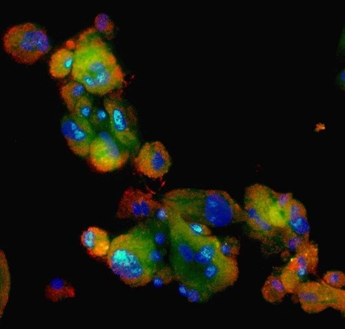 RNA in vivo detekcia v bunkách karcinómu tráviacej trubice