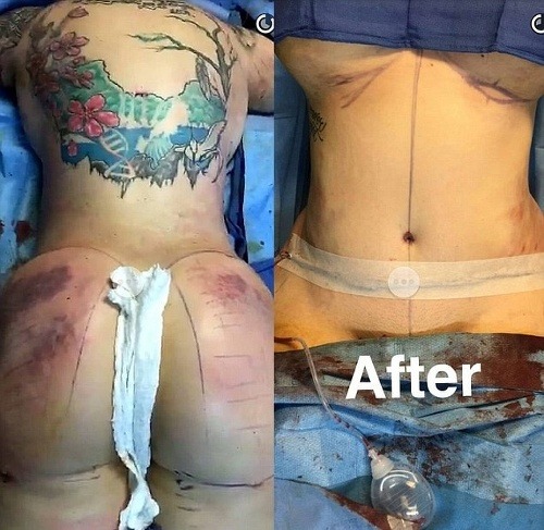 Dr. Miami odobral Kailyn tuk z brucha, vylepšil jej prsia a zadok. 