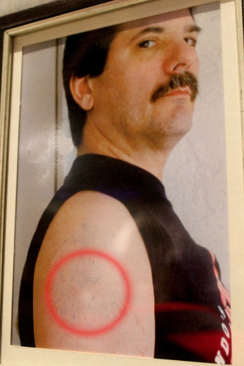 Muž sa zbavil tetovania