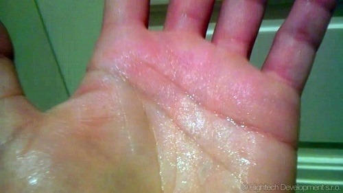 Nadmerné potenie je choroba,