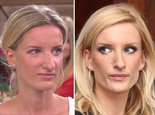 Začiatkom roka sa prevalilo, že Adela Banášová navštívila kliniku krásy, aby podstúpila menší zákrok. Nechala si odstrániť výrastok (foto vpravo) na pravej stráne tváre vedľa nosa. 