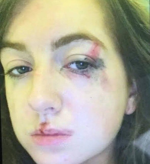 Emily utrpela zranenia na tvári