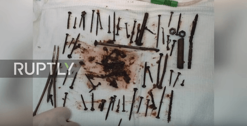 Obsah žalúdka ruskej dôchodkyne