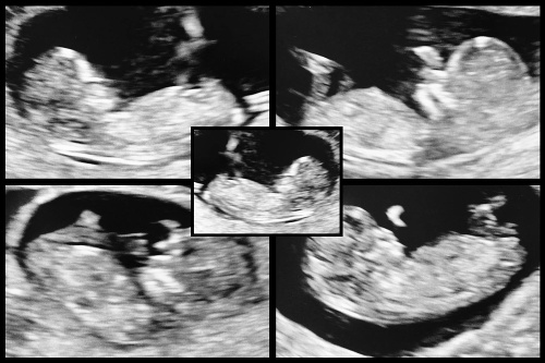 Snímka pätorčiat z ultrazvuku 