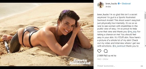Brenna Huckaby je prvou kráskou so zdravotným znevýhodnením, ktorá pózovala pre Sports Illustrated. 