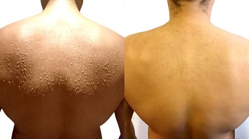 Trpíte nadmerným potením? Usušíme