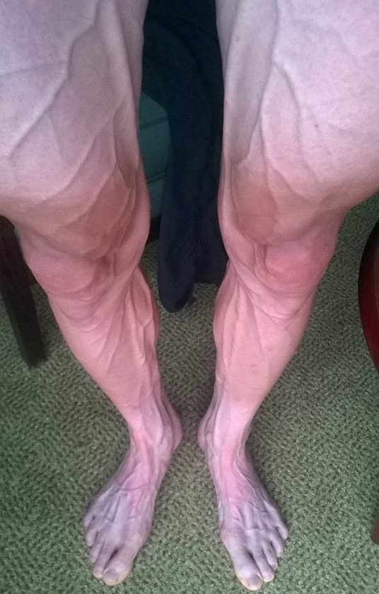 Takto vyzerali nohy cyklistu Bartosza Huzarskiho po náročných pretekoch Tour de France. (Foto: Facebook.com)