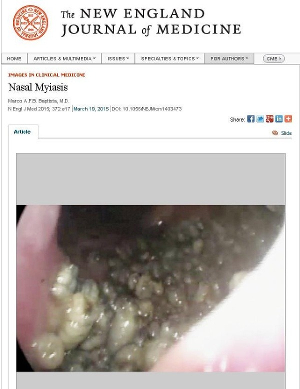 Lekári našli v mužovom nose stovky mäsožravých červíkov. (Foto: screenshot Nejm.org)