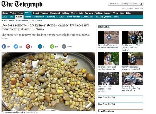 Takto vyzerali obličkové kamene pacienta (screenshoot zo stránky The Telegraph)