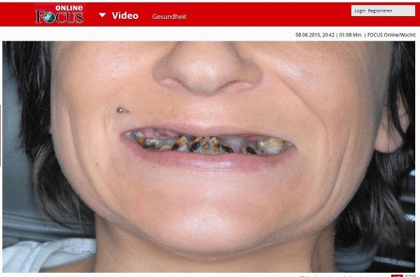 Takýto je výsledok po 15 rokoch ignorovania zubnej hygieny. (Foto: screenshot Focus.de)