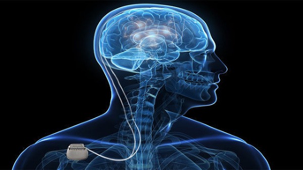 Neurostimulátor je implantovaný pod kožu v oblasti pod kľúčnou kosťou pacienta a spojený s mozgom prostredníctvom elektród. (Foto: Tlačová správa)