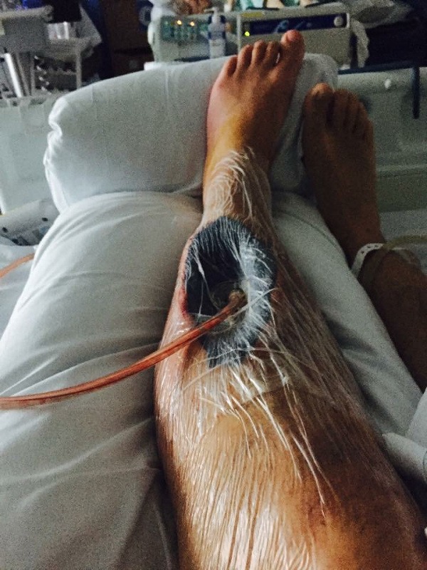 Lekári museli Lewisovi vyrezať sval z nohy, ktorý mu odumrel. (Foto: Profimedia.sk)