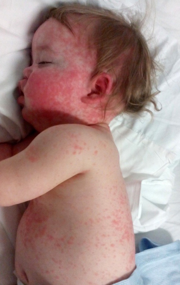 Chlapček mal na celom tele červené pľuzgiere. (Foto: Profimedia.sk)