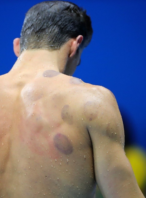 Červené kruhy na chrbte Michaela Phelpsa nie sú ničím výnimočným (zdroj: profimedia.sk) 