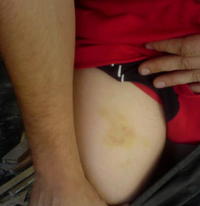 Zdeno tvrdí, že mu túto modrinu spôsobili policajti.