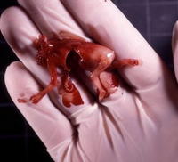 Kontroverzná billboardová kampaň s fotografiami plodu zabitého pri umelom potrate