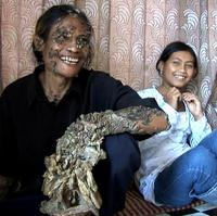 Dedemu narástla na tele obrovská kôrová bradavica.