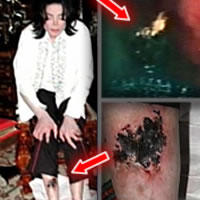 Zranenia Michaela Jacksona