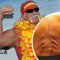 Hulk Hogan strávil Vianoce s hrozivými ranami na chrbte