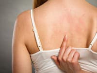 Šesť kožných príznakov nákazy OMIKRON na koži, ktoré nikdy neignorujte