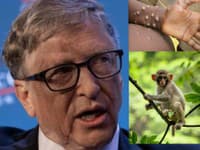 Svet začínajú ohrozovať opičie kiahne: Teória Billa Gatesa nás môže do budúcna zachrániť