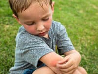 Expert radí rodičom: Poštípal komár vaše deti? Najlepší trik na ošetrenie rany a zbavenie svrbenia