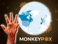 AKTUÁLNE Na Slovensku potvrdili tretí prípad opičích kiahní