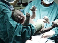 Unikátna FOTO z pôrodu cisárskym rezom: Chlapček sa narodil v... ozaj zriedkavý fenomén!