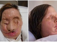 Carla pred a po transplantácii