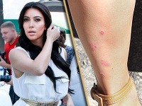Kim Kardashian pred svadobným dňom trápia červené fľaky na tele. Kim Kardashian pred svadobným dňom trápia červené fľaky na tele.