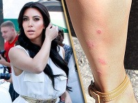 Kim Kardashian pred svadobným dňom trápia červené fľaky na tele.