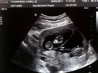 Ultrazvuk odhalil, že rodičia nečakajú jedno, ani dve, ale tri deti